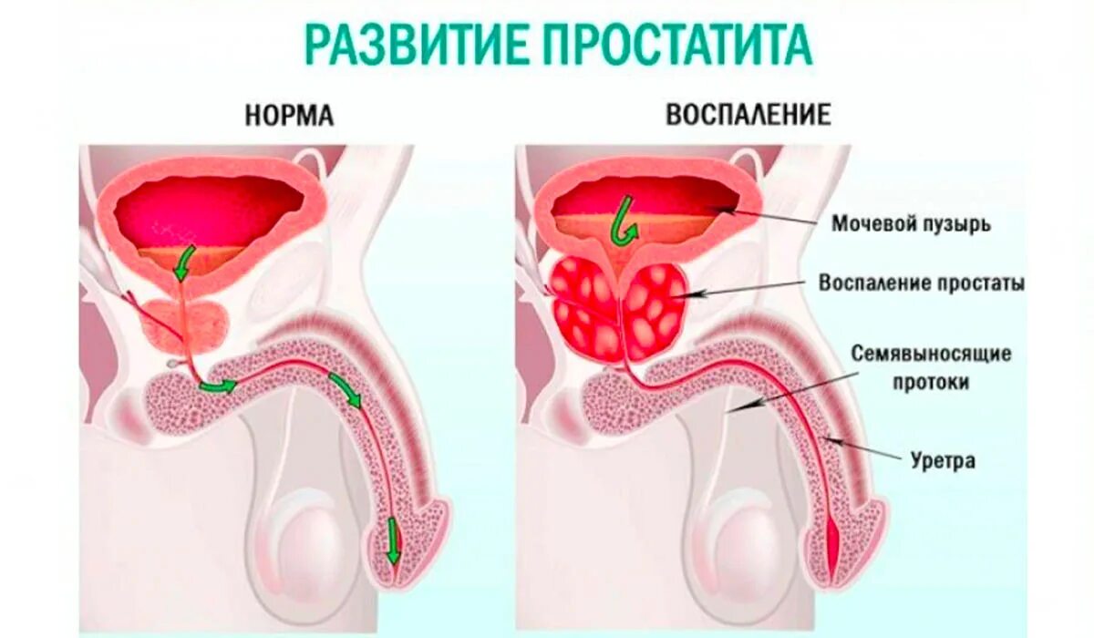 Воспалить простату. Простатит предстательной железы.