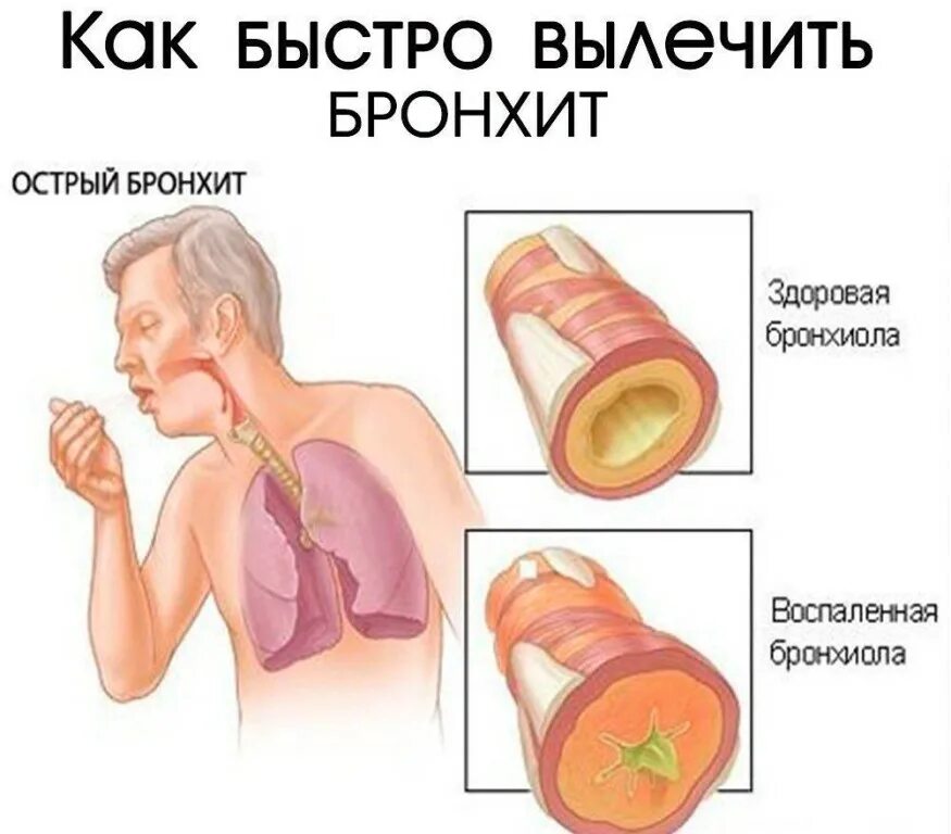 Бронхит заразен или