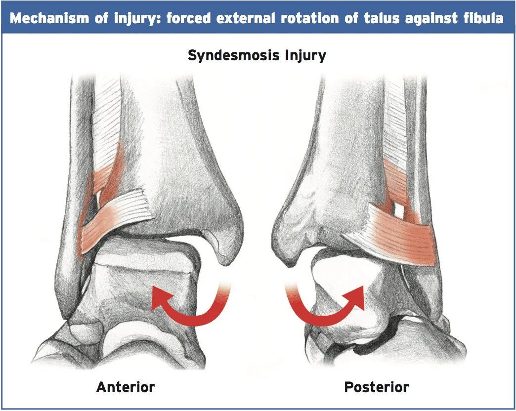 Дистальный разрыв. Перелом лодыжки синдесмоз. Связки дистального межберцового синдесмоза. Разрыв связок межберцового синдесмоза. Синдесмоза голеностопного связки.
