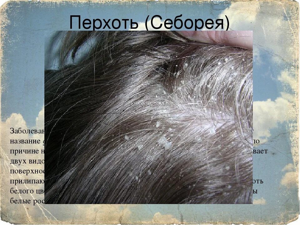 Себорея кожи головы причины и лечение фото Effective remedies for the treatment of dandruff Shampoo for hair Nizoral for th