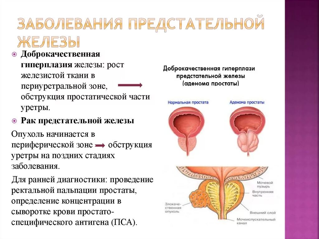 Поражение предстательной железы