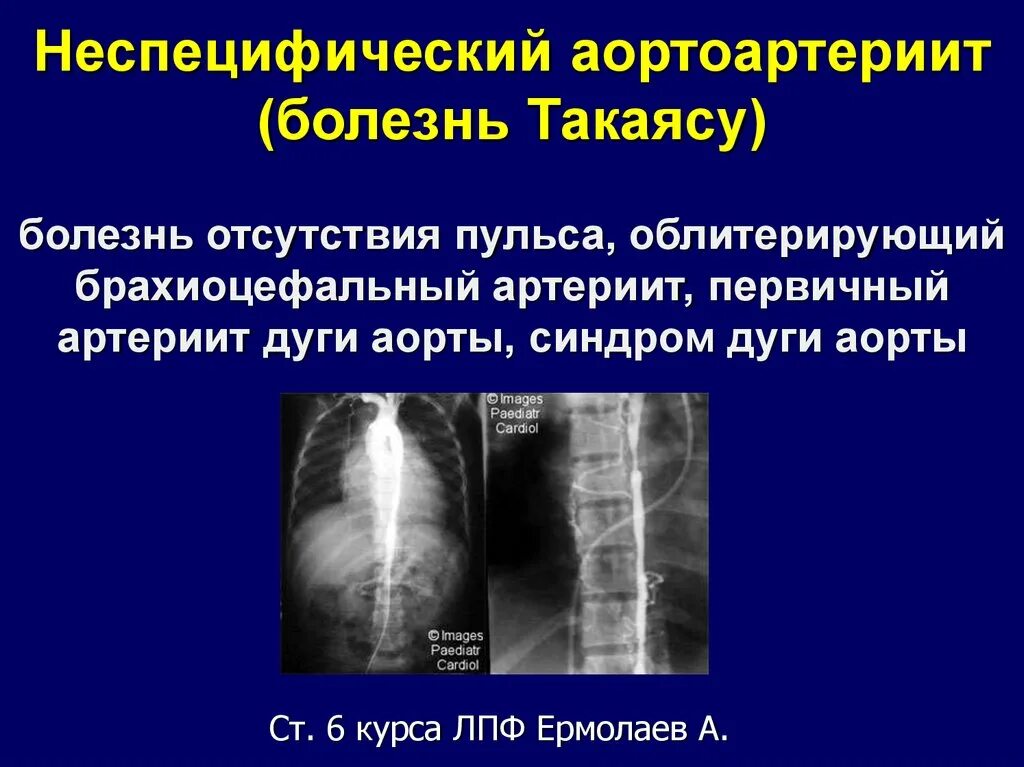 Болезнь такаясу клинические. Неспецифический аортоартериит болезнь такаясу. Неспецифический аортоартериит болезнь такаясу. Неспецифический аортоартериит болезнь такаясу. Болезнь такаясу клинические.