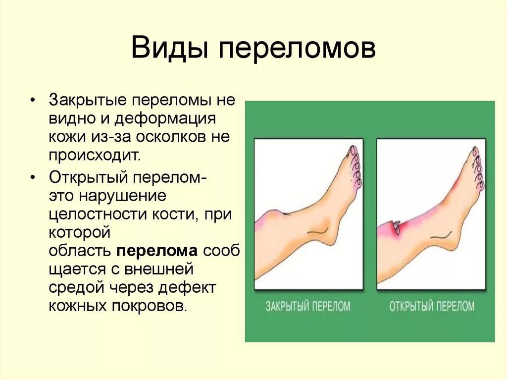 Виды переломов и первая помощь при них. Переломы по степени нарушения целостности кости. Типы переломов конечностей..