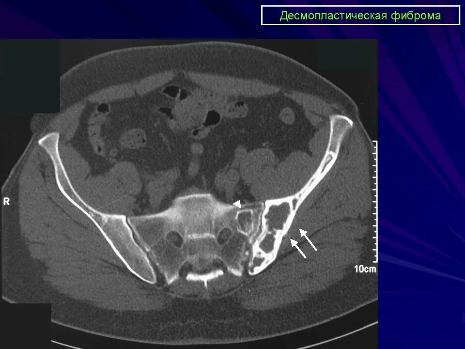 Кт подвздошной кости. Опухоль подвздошной кости на кт. Фиброзная дисплазия подвздошной кости на кт. Фиброма бедренной кости кт. Десмопластическая фиброма на кт.