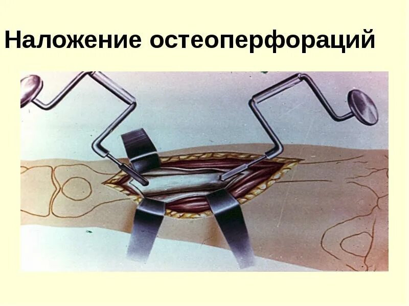 Гематогенный остеомиелит у детей клинические рекомендации. Остеоперфорация при остеомиелите. Острый гематогенный остеомиелит у детей клинические рекомендации. Остеотонометрия. Диагностика анамнез.
