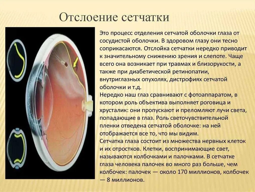 Как лечится отслоение сетчатки глаза. Отслоение сетчатки глаза причины. причины первичной отслойки сетчатки.