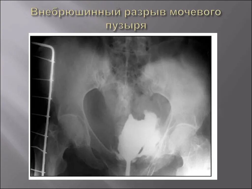 Внутрибрюшинная травма мочевого пузыря. Цистография разрыв мочевого пузыря. Травма мочевого пузыря рентген. Восходящая цистография мочевого пузыря.