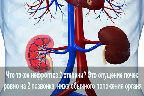 Нефроптоз мкб