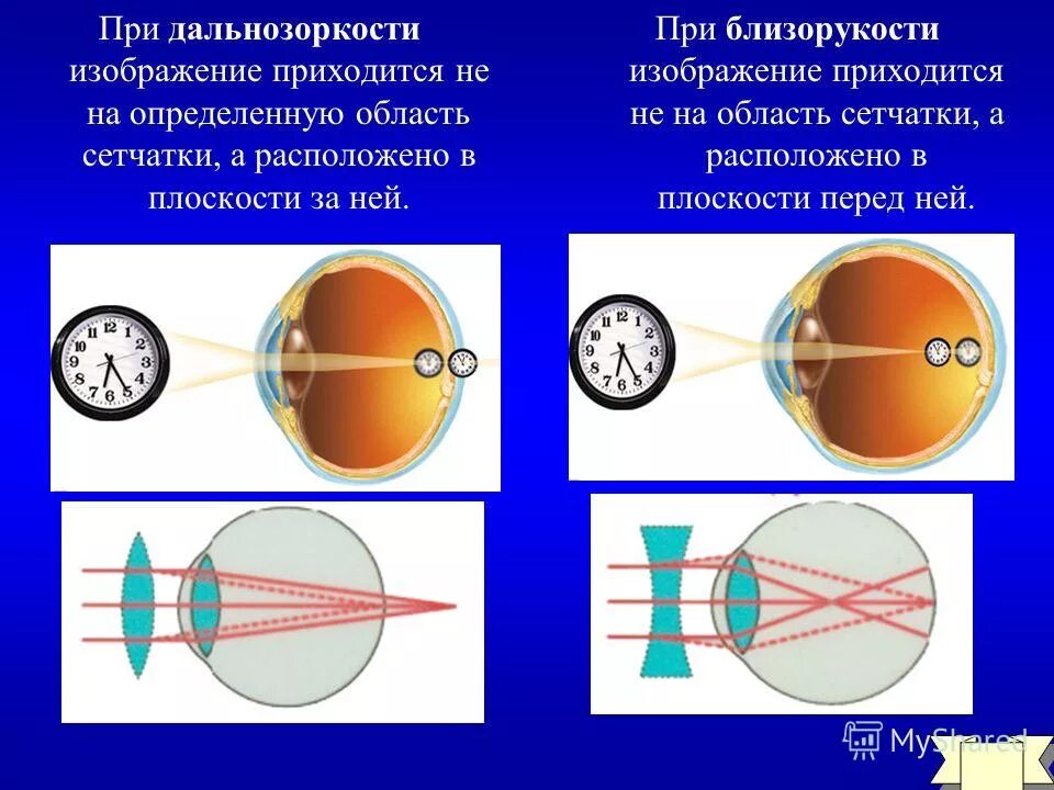 Изображение на сетчатке глаза появляется. Близорукость это миопия а дальнозоркость это. Дальнозоркость и близорукость строение глаза. Близорукость форма глазного яблока. Миопия и гиперметропия.