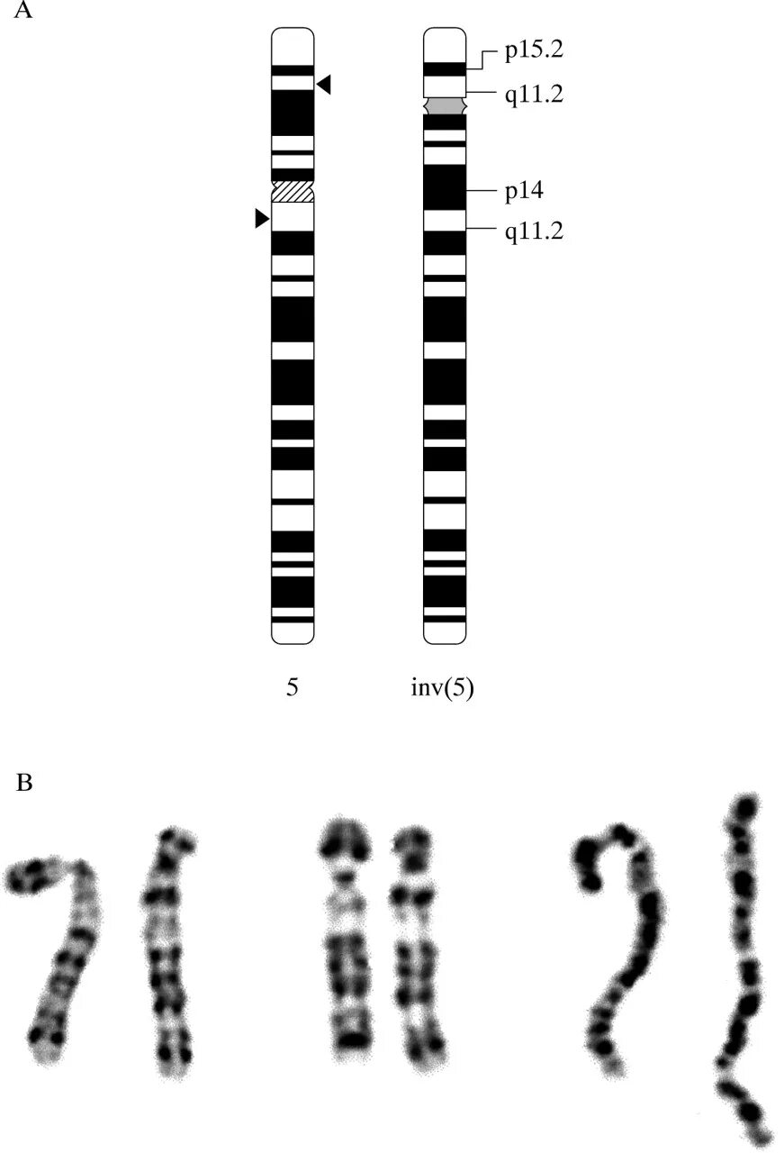 Моносомия длинного плеча 5 хромосомы. Хромосома 3й 10й. Мужская хромосома 5