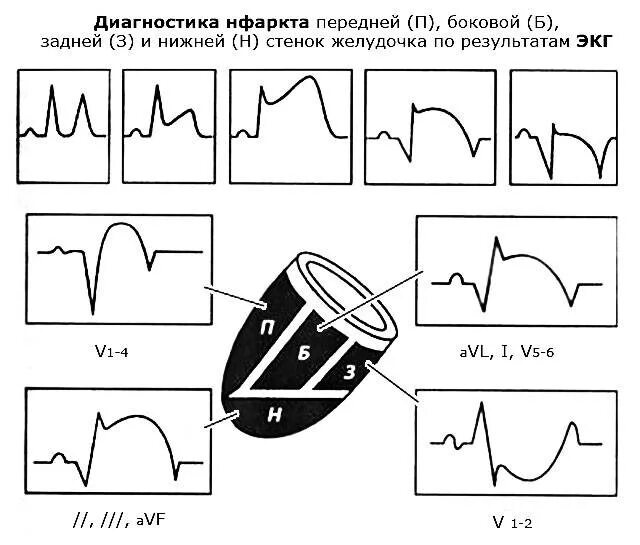 Трансмуральный задний инфаркт левого желудочка. Инфаркт миокарда нижней стенки экг. Инфаркт миокарда по задней стенке левого желудочка. Трансмуральный задний инфаркт левого желудочка. Трансмуральный инфаркт миокарда задней стенки.