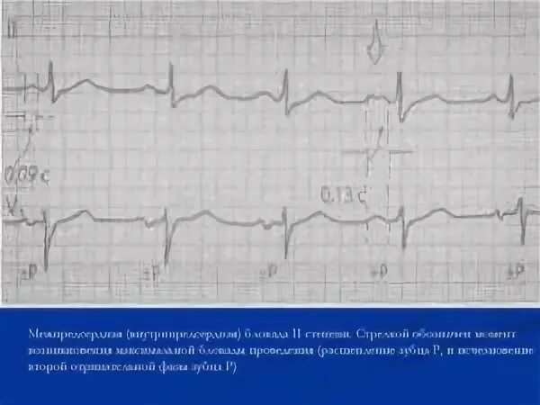 Что значит внутрипредсердная внутрипредсердная блокада. ЭКГ при внутрипредсердной блокаде. Внутрипредсердная блокада 1 степени. Замедление АВ проводимости на ЭКГ. Для внутрипредсердной блокады характерно.