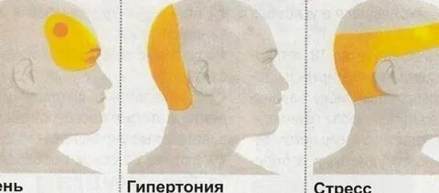 Как снять мигрень