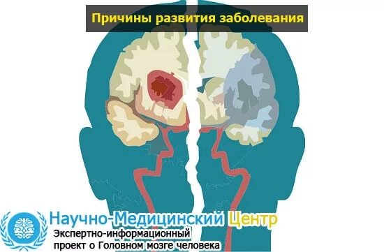 Причины гипоксии мозга. Кислородное голодание мозга. Кислородное голодание мозга симптомы. Гипоксия головного мозга. Симптомы кислородного голодания головного мозга.