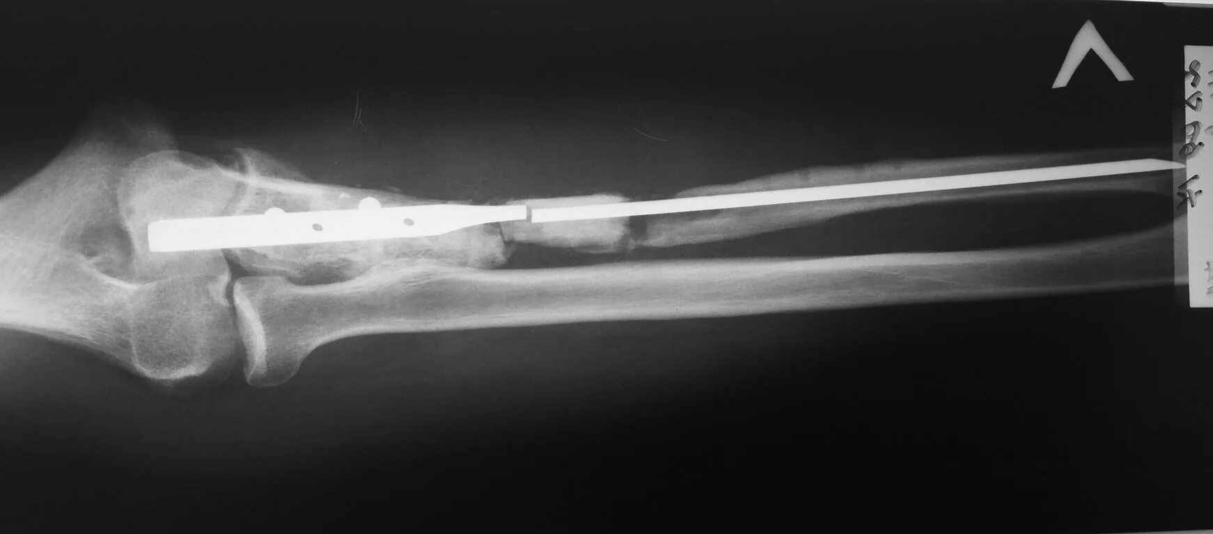 вколоченный перелом предплечья. перелом лучевой кости рентген. остеосинтез переломов локтевой кости. спицы при переломе лучевой кости со смещением. остеосинтез лучевой кости.