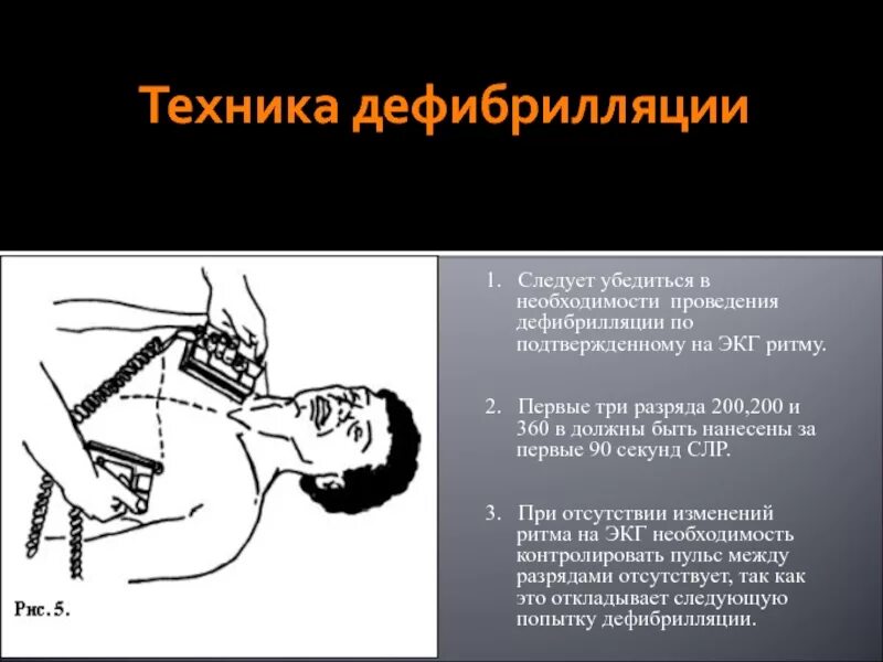 Проведение дефибрилляции сердца. Электрическая дефибрилляция методика проведения. дефибриллятор. методика проведения дефибрилляции. техника проведения электрической дефибрилляции.. дефибрилляция показания методика проведения.