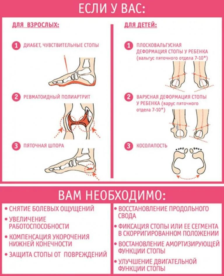 Деформация стопы у взрослых лечение гимнастика вальгусная. Ортопедические стельки при вальгусной деформации пальца. плоско вальгусная деформация стопы стелька. вальгус у детей упражнения. рекомендации ребенку с вальгусной стопой.