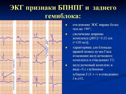 Неполная блокада пучка гиса симптомы