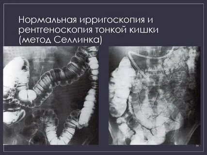 Исследование толстой кишки ирригоскопия