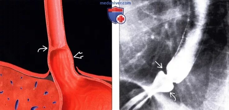Кольцо шацкого в пищеводе. Пищеводное кольцо Шацкого. Сужение пищевода кольцо Шацкого. Грыжа пищеводного отверстия диафрагмы и кольцо Шацкого.