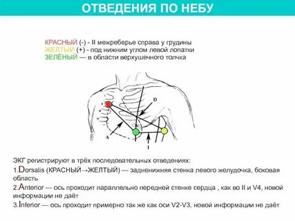 Наложение электродов при экг схема по цветам