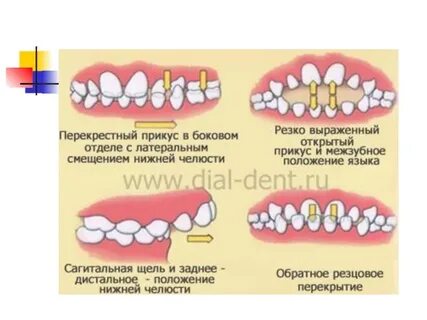 Ребенку год неправильный прикус