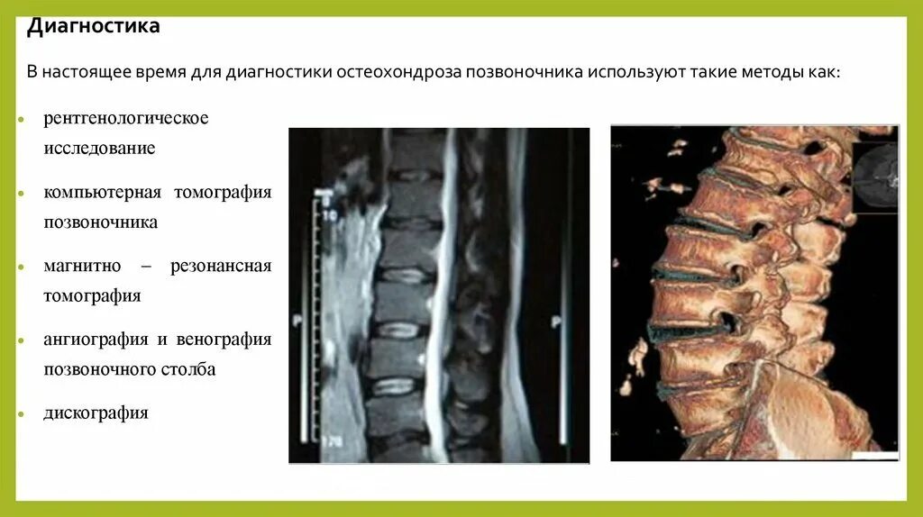 Обследование при остеохондрозе поясничного отдела. Диагноз остеохондроз поясничного отдела позвоночника. Позвонки шейного отдела при остеохондрозе. Клинические проявления остеохондроза.