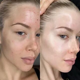 Tc duo peel