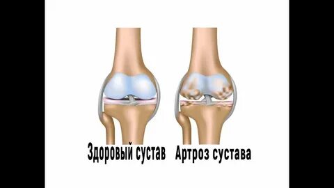 Санаторий лечение артрита артроза