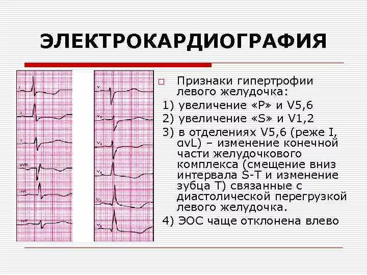 Глж на экг что это значит