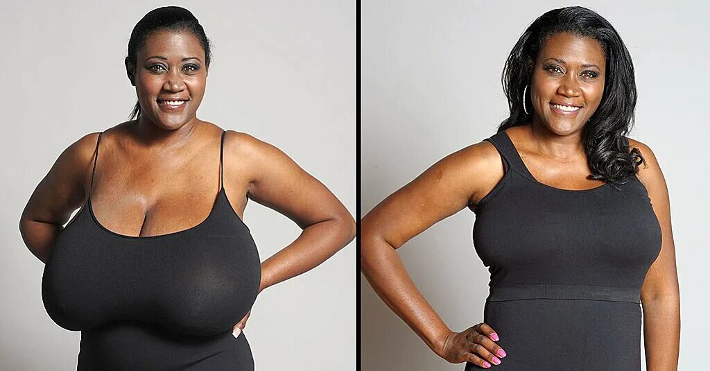 Уменьшение груди. Операция по уменьшению г. Гигантомастия операция. Уменьшение и подтяжка. Пластика мужской груди.