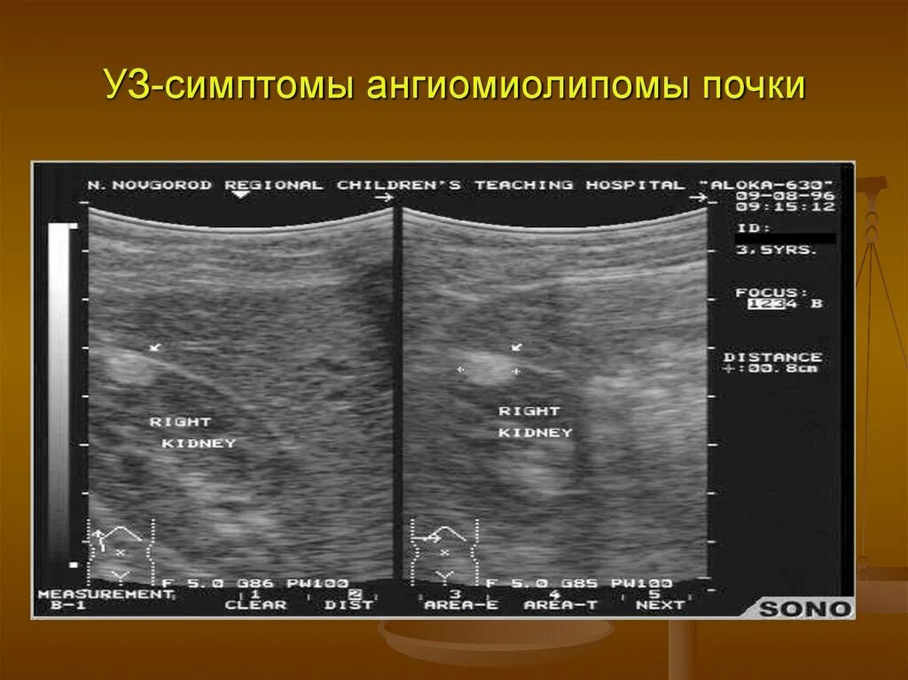 Очаговые изменения почки. Ангиомиолипома почки на УЗИ. Объемное образование левой почки ангиомиолипома. Ангиомиофиброма почки. Ангиомиолипома левой почки что это такое.