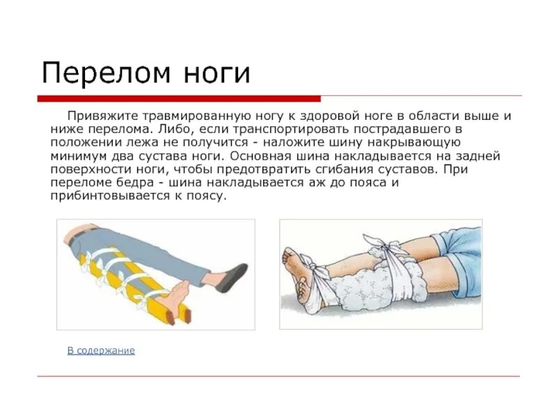 ПМП при переломе костей конечностей. Открытый перелом голени первая помощь транспортировка пострадавшего. ПМП при переломе голени. Способы оказания первой помощи при переломе нижней конечности.