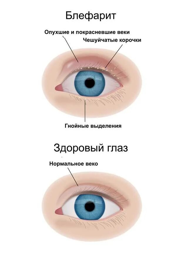 Веках почему е. Трахома. Конъюнктивит. Кератит. Блефарит.. Блефарит — это воспаление век. Блефарит (воспаление кожи век).. Глазная болезнь блефарит блефарит.