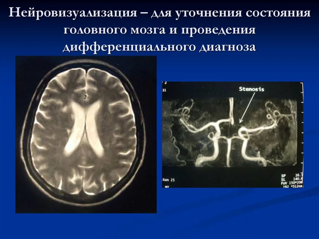 Нейровизуализация головного мозга. Цереброваскулярные заболевания. Цереброваскулярный синдром. Цереброваскулярные болезни классификация.