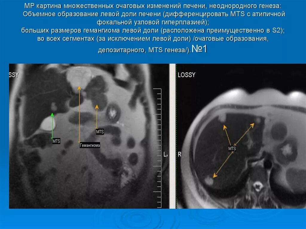 Множественные образования в печени. Образование правой доли печени. Множественные очаговые образования в печени. Множественные очаговые поражения печени.