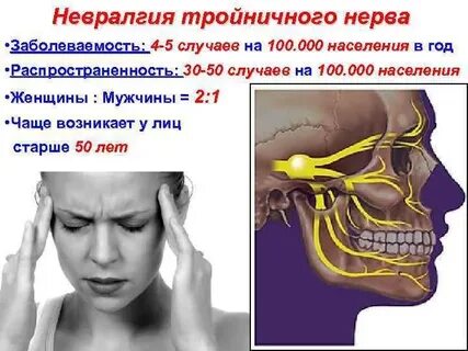 Признак невралгии тройничного нерва