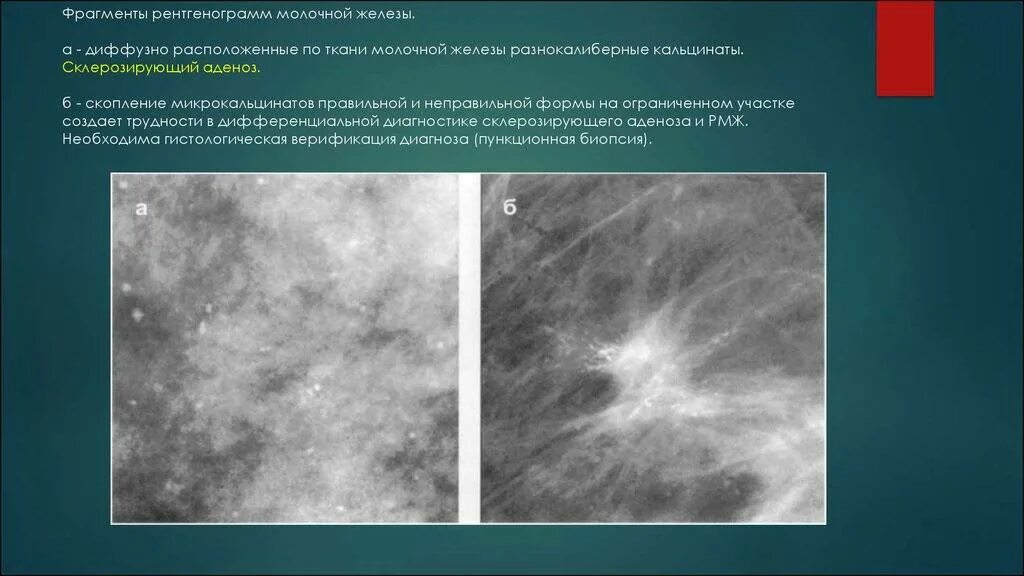 Диффузная мастопатия фиброзным компонентом. Кистозная мастопатия маммография. Склерозирующий аденоз молочной железы маммография. Аденоз молочной железы рентген.