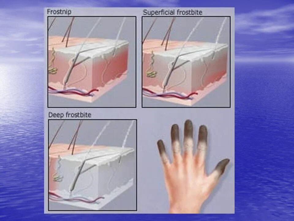 Отморожение кожи 4 степени. 3 Степень обморожения кожи. Обморожение рук 1 степени. Степени обморожения 4 степени.