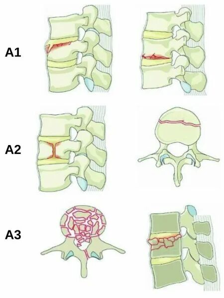 Компрессионный перелом позвоночника л1. Компрессионный перелом л1 позвонка. Компрессионный перелом l2 позвонка поясничного отдела. Компрессионный перелом позвоночника т11.