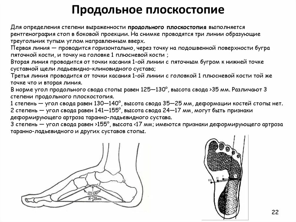 Поперечное 1 степени. Плоскостопие поперечный свод. Продольное плоскостопие стоп 3 степени. Продольное плоскостопие схема измерения. Плоскостопие 3 степени высота свода.