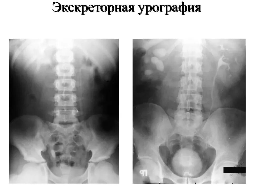 Рентген мочеточника. Обзорная рентгенография урография. 1) Экскреторная урография. Аплазия мочеточника рентген. Внутренняя урография почек.