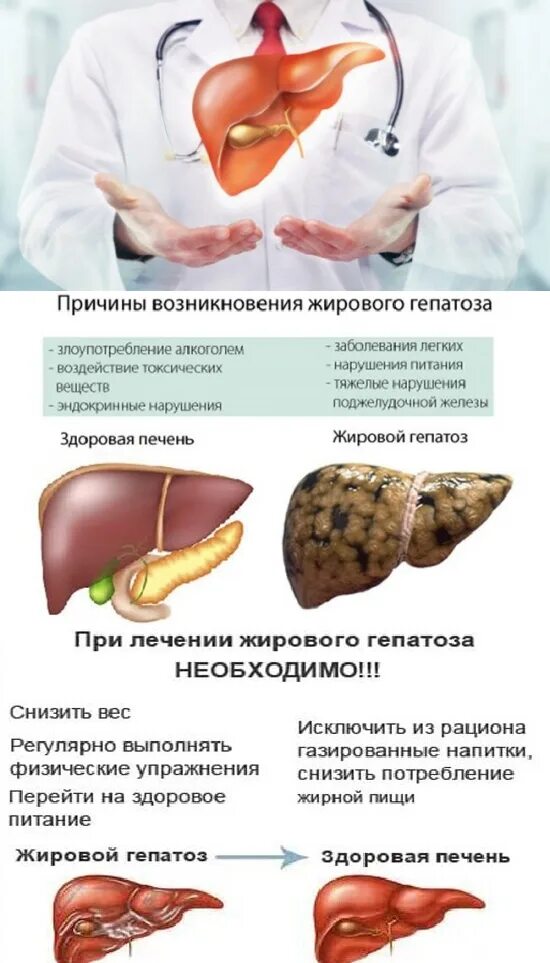 Чем опасна жировая печень. Жировой гепатоз симптомы. Симптомы жирового гепатоза. Жировой гепатоз печени. Жировой гепатоз холелитиаз.