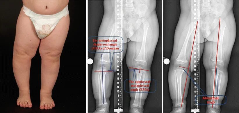 Укорочение трубчатых. Болезнь Блаунта рентген. Болезнь Эрлахера Блаунта презентация. Болезнь Блаунта у детей рентген.