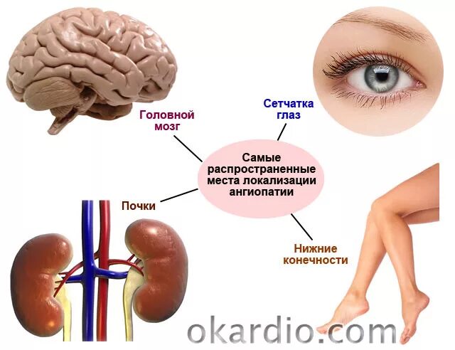 Нижних конечностей и головного мозга. При ангиопатии. Ангиопатия сосудов головного. Микроангиопатия сосудов головного мозга. Вазопатии этиология патогенез.