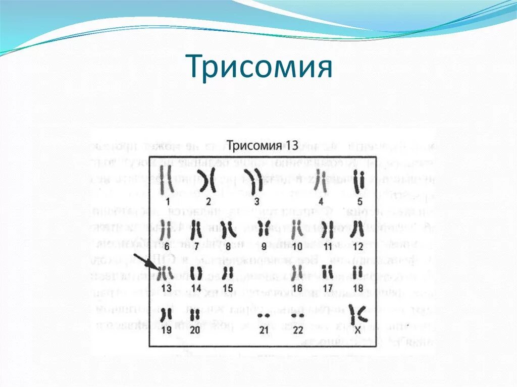 Трипло х. Трисомия по 21 хромосоме кариотип. Трисомия х кариотип. Кариотипы генетических заболеваний.