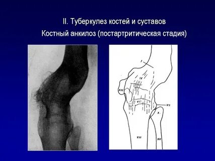 Туберкулез костно суставной системы