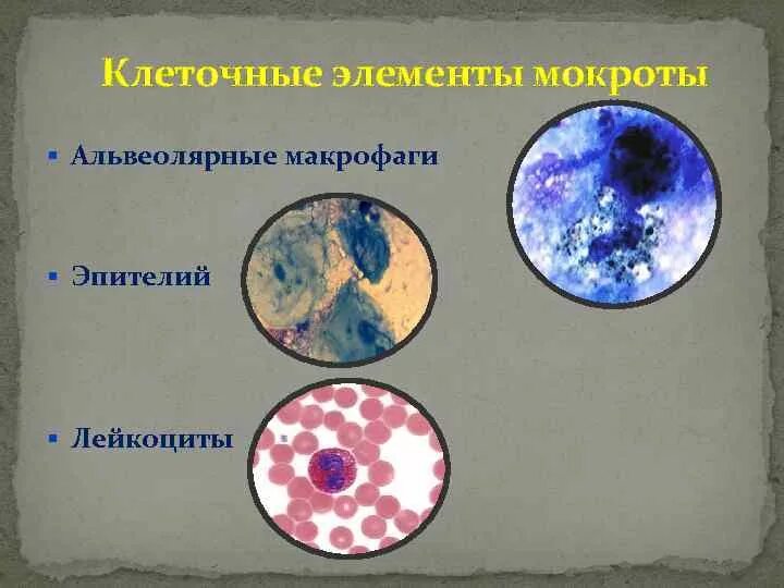 Элементы мокроты. Альвеолярные макрофаги в мокроте микроскопия. Исследование мокроты спирали Куршмана. Клеточные элементы мокроты микроскопия. Микроскопия мокроты нативного.