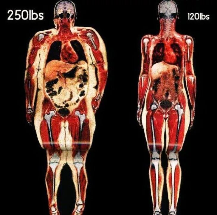 Толстый человек анатомия. Широкая кость. Полный скелет человека. Скелет полного и худого человека. Люди с широкими костями.
