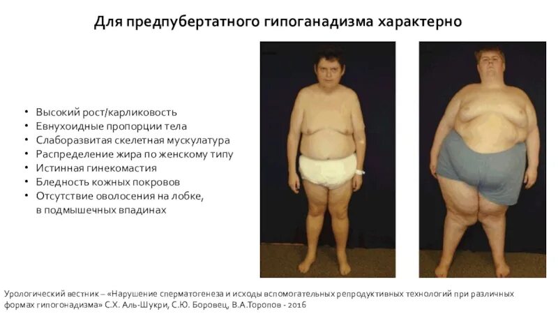 Клинические признаки синдрома клайнфельтера. Адипозогенитальная дистрофия (болезнь бабинского - фрелиха). 11. Синдром клайнфельтера. Евнухоидный тип телосложения.